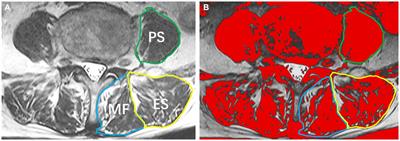 Paraspinal muscle parameters’ predictive value for new vertebral compression fractures post-vertebral augmentation: Nomogram development and validation